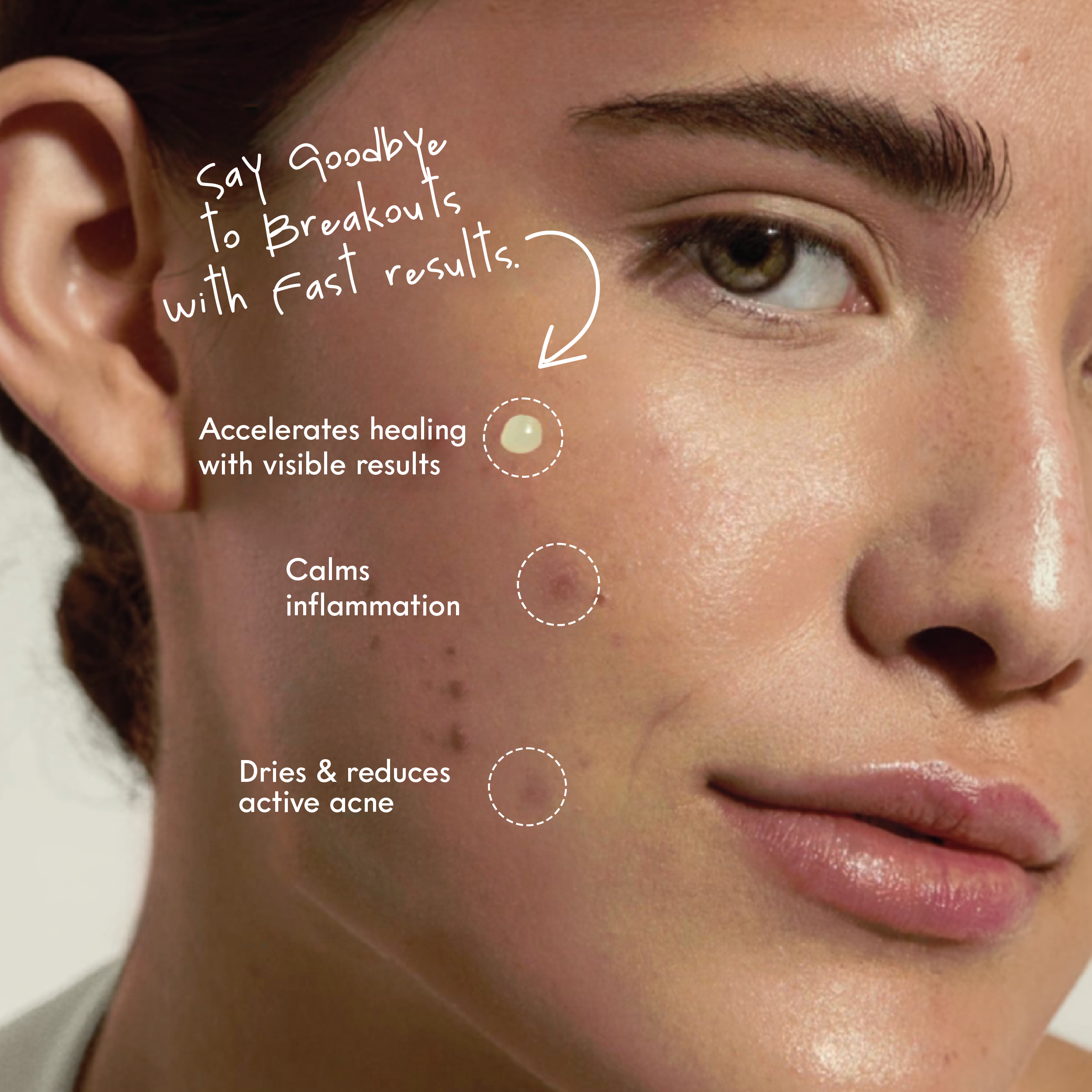 SKIN DEFENSE ACNE SPOT GEL 4